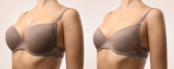 Man sieht das Ergebnis einer Brustverkleinerung: links eine Frau mit großen Brüsten, rechts dieselbe Frau mit kleineren Brüsten