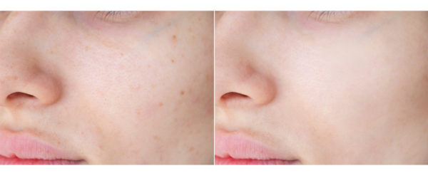 Pigmentflecken im Gesicht entfernen vorher-nachher