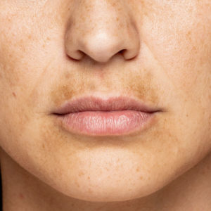 Frau mit Pigmentflecken im Gesicht