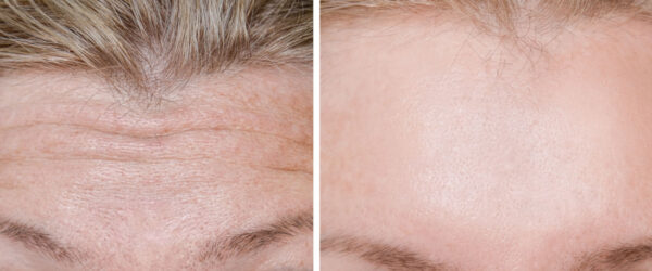 Falten auf der Stirn vor und nach einer Botox-Behandlung