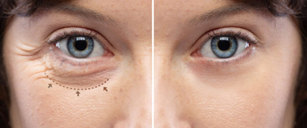 Augenlidstraffung: Vorher-nachher-Vergleich