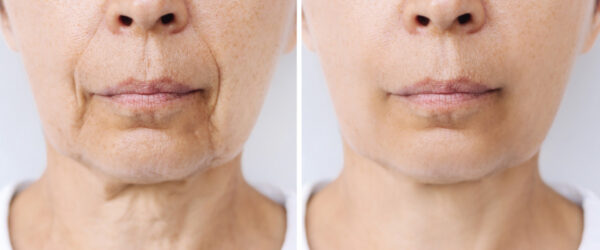 Facelifting: vorher und nachher Facelifting vorher/nachher-Bilder einer Frau mittleren Alters