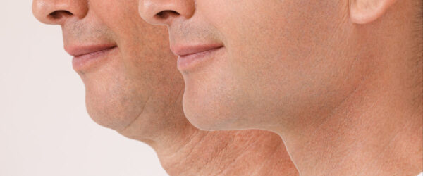 Halslifting und Facelifting vorher/nachher Mann vor und nach einem Halslifting und Facelifting